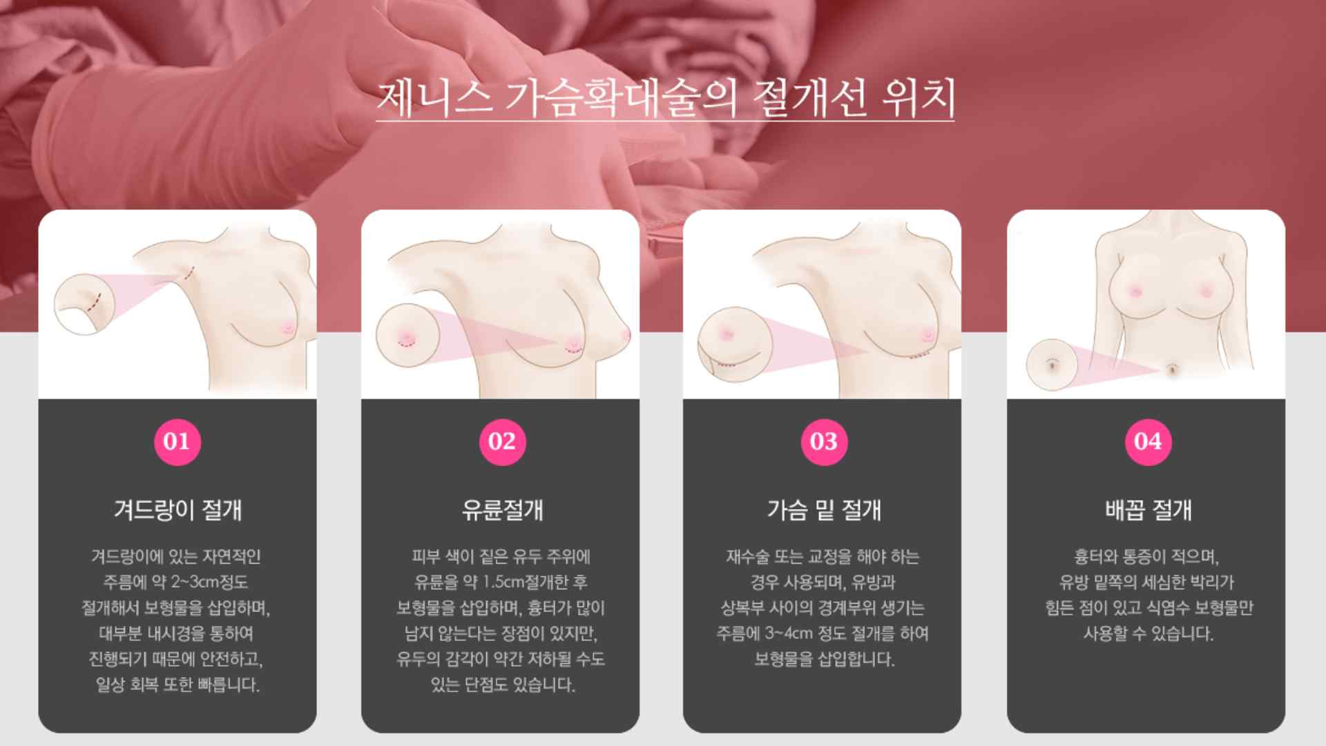 隆乳假體植入位置,高雄隆乳醫美,高雄隆乳說明