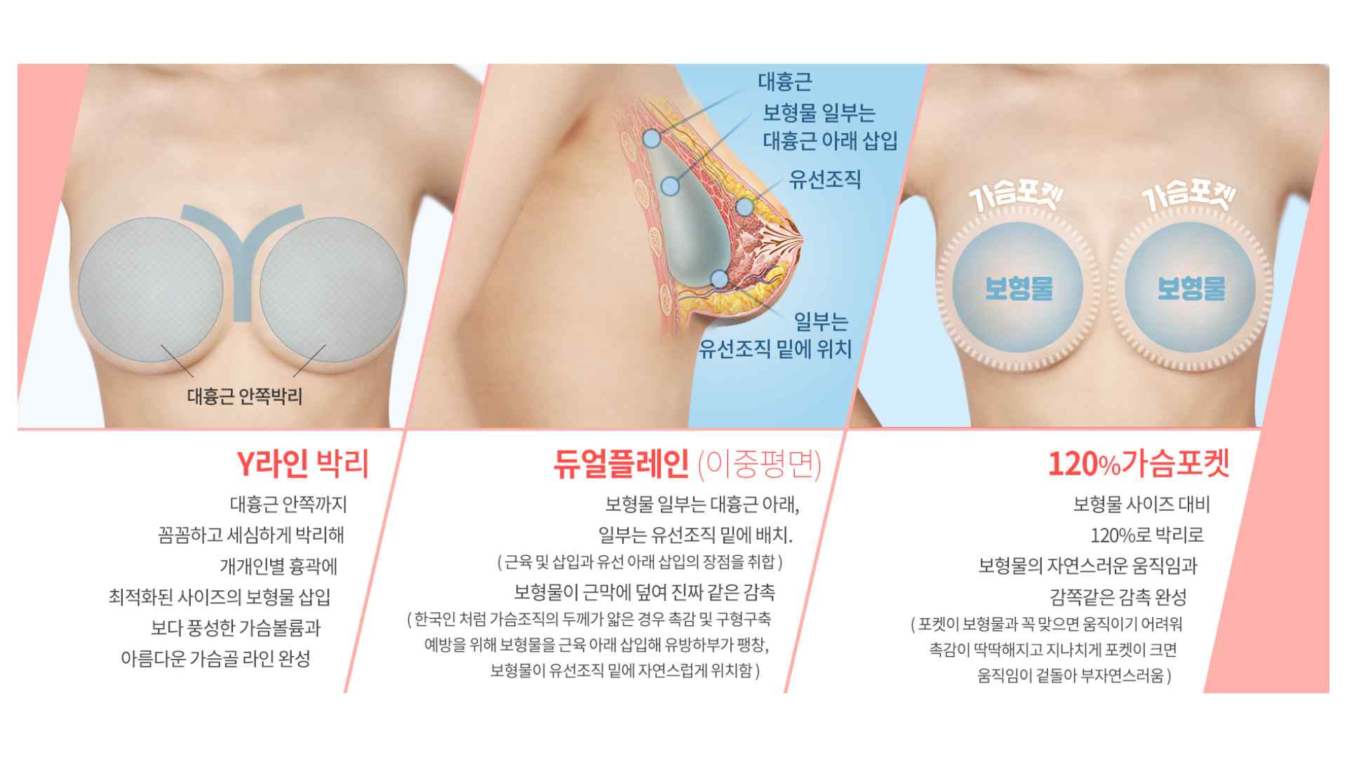 隆乳假體位置示意,高雄隆乳診所,隆乳手術假體