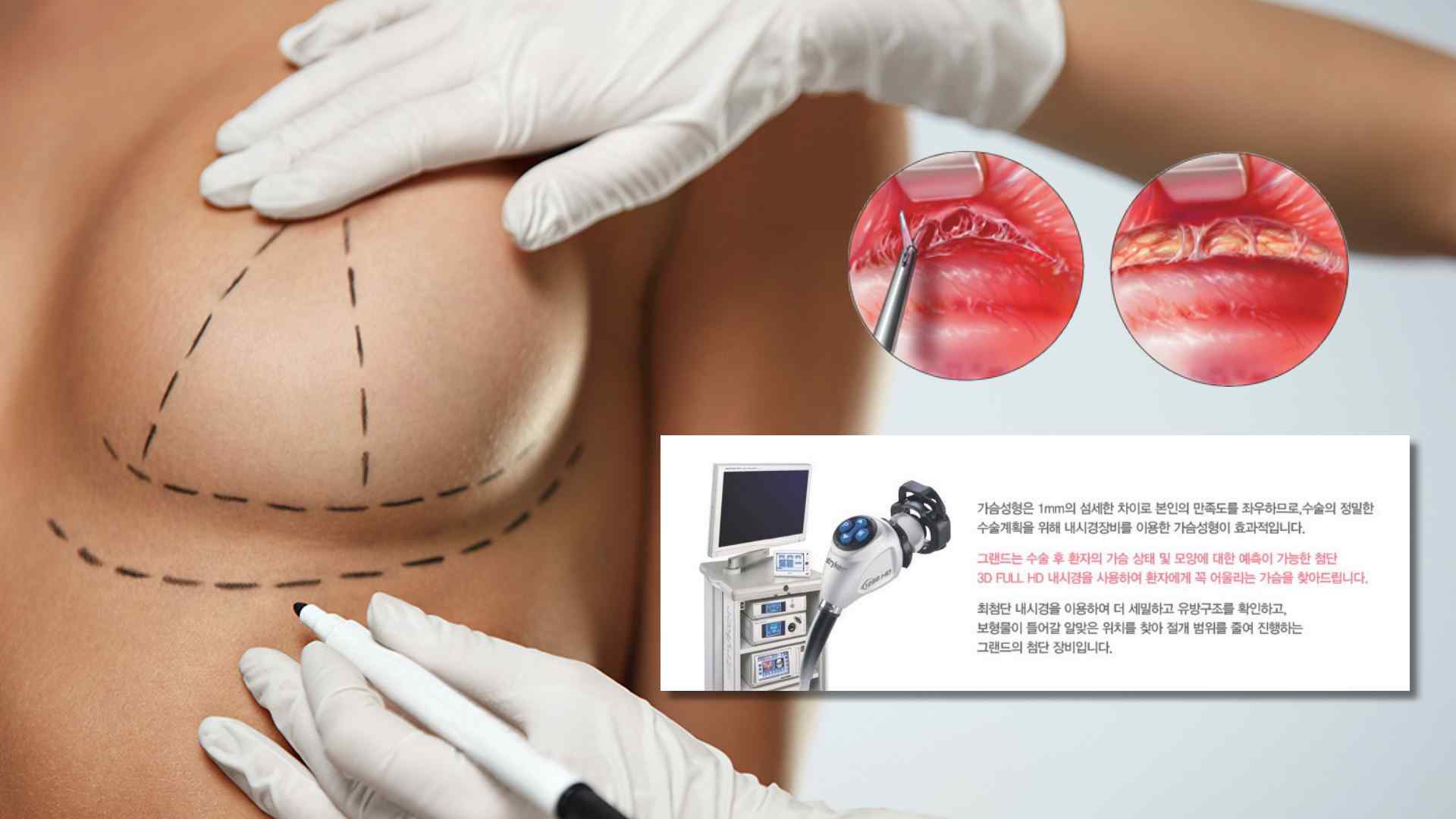 隆乳輔助工具,內視鏡隆乳,高雄內視鏡隆乳