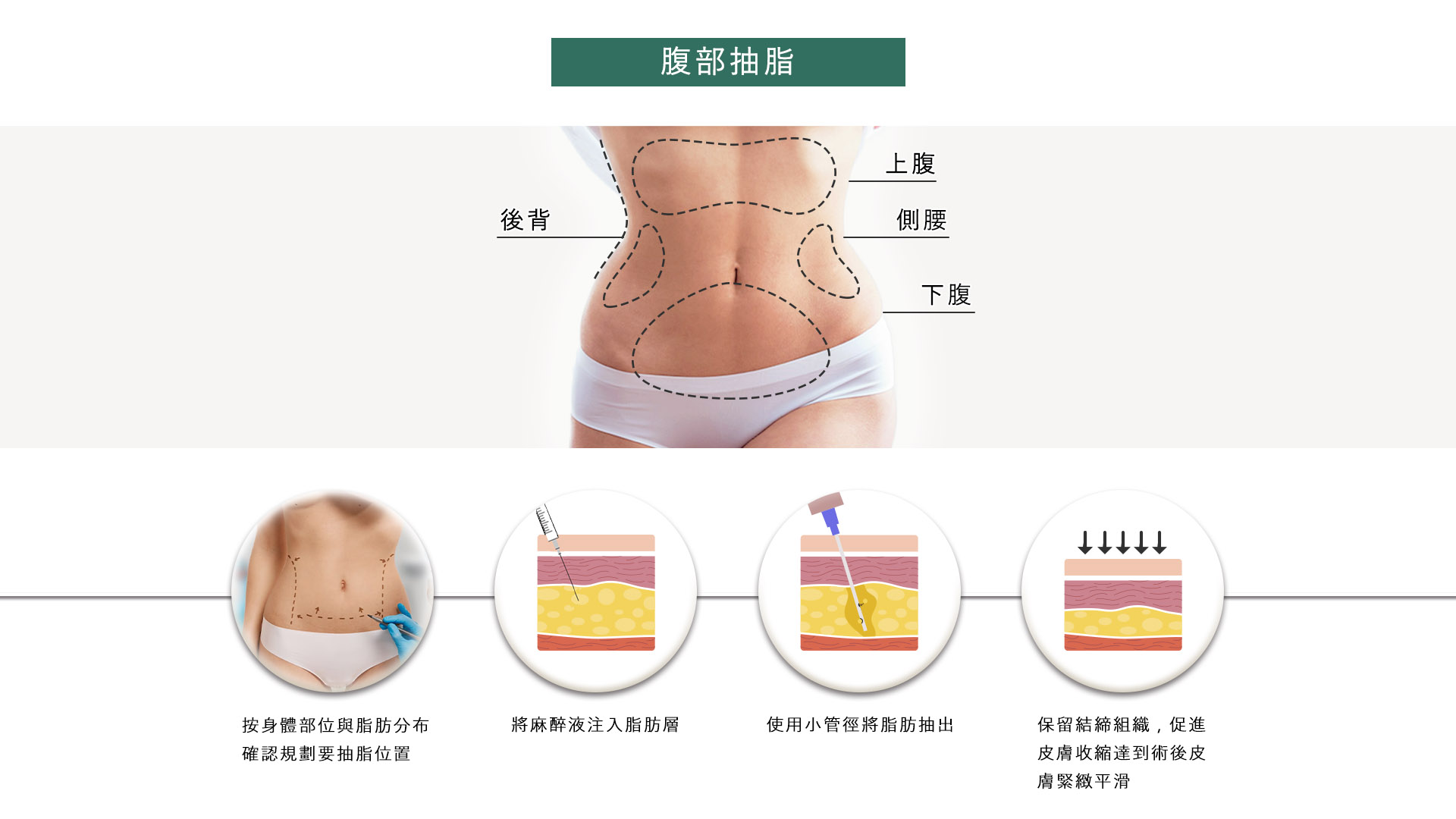 高雄抽脂手術_永恆醫美