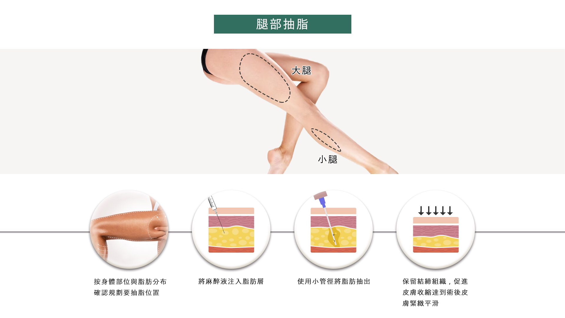 高雄抽脂手術_永恆醫美