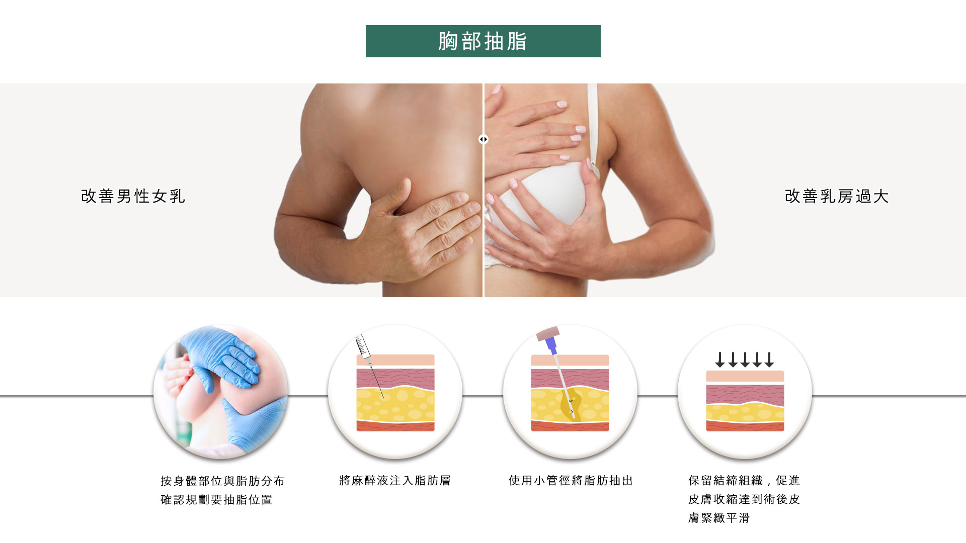 高雄抽脂手術_永恆醫美