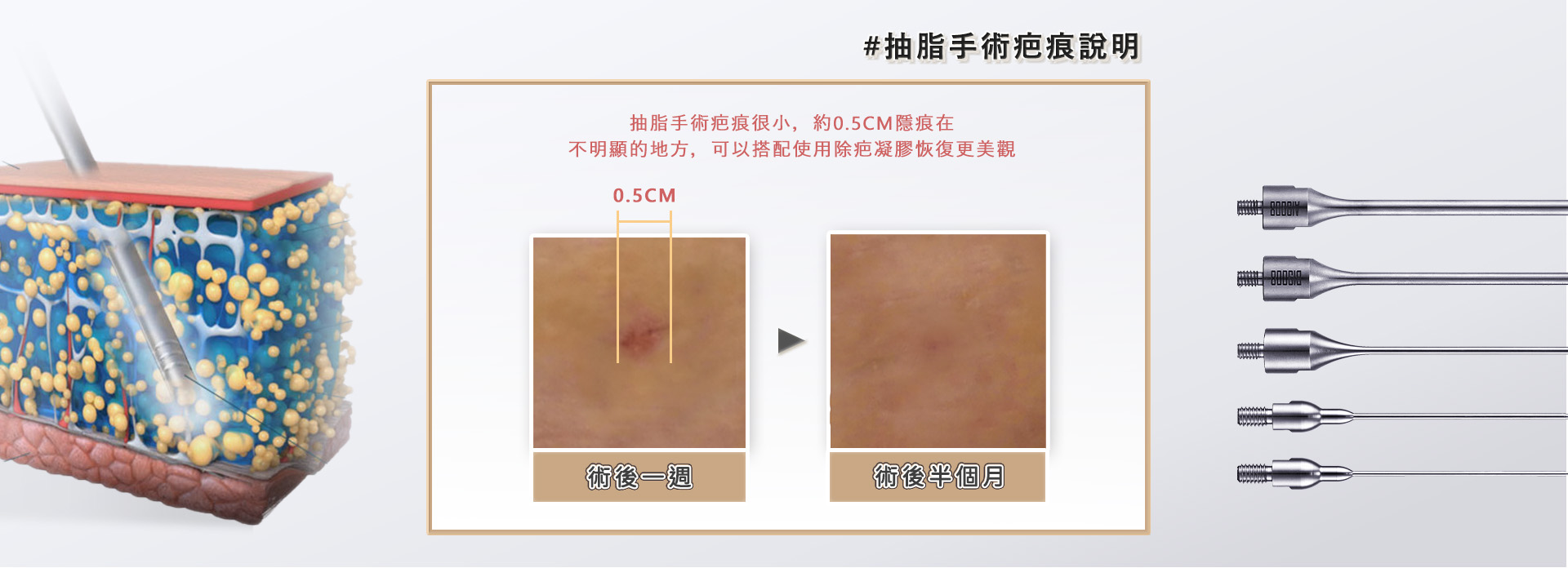 高雄抽脂手術_永恆醫美