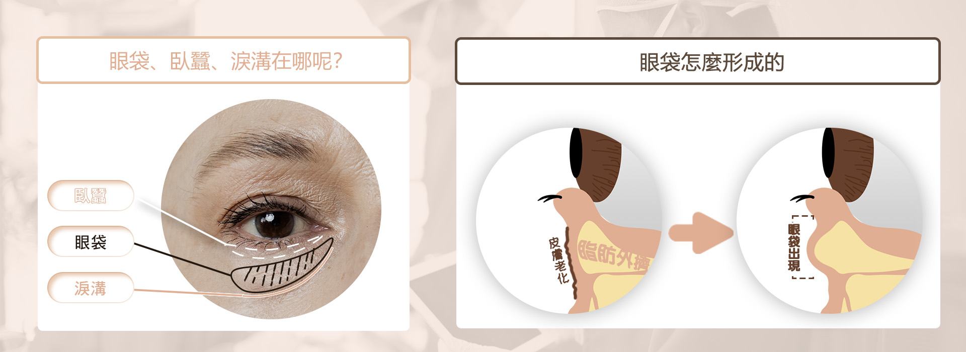 高雄眼袋手術_眼袋手術