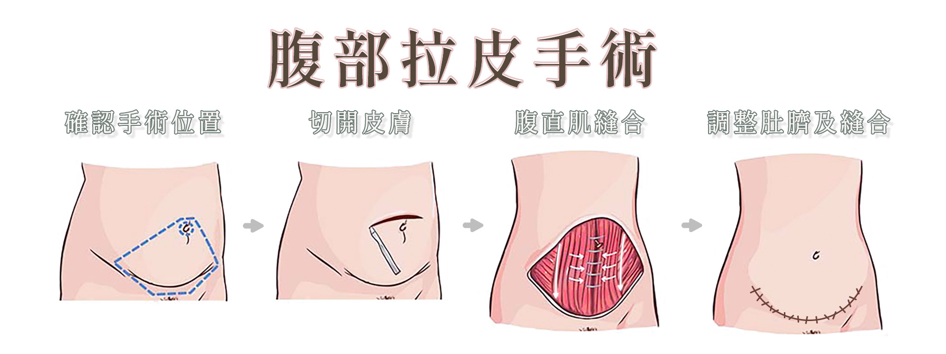 高雄腹部拉皮權威醫師推薦價格費用003
