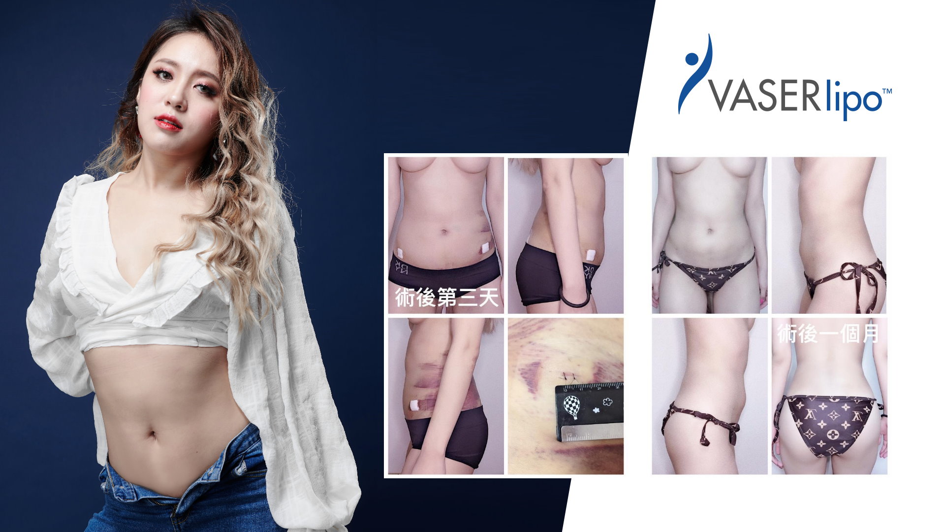 高雄抽脂手術_永恆醫美