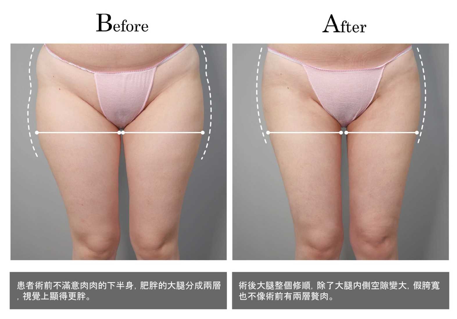 高雄抽脂手術_永恆醫美