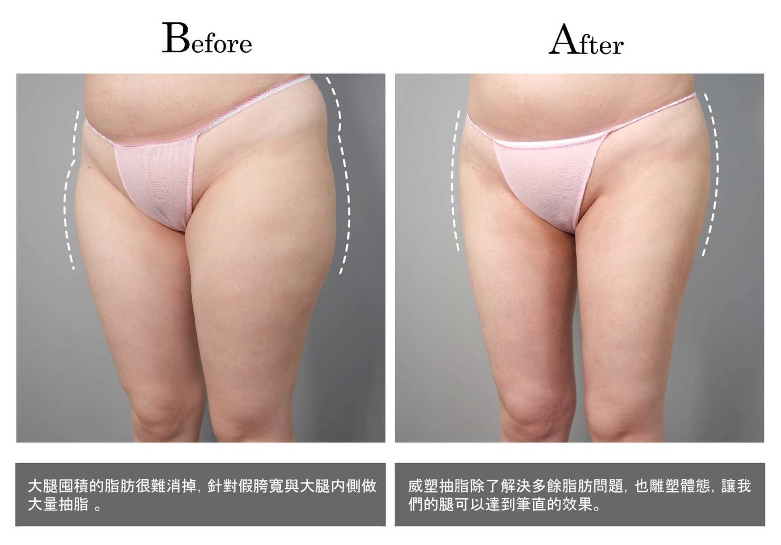 高雄抽脂手術_永恆醫美