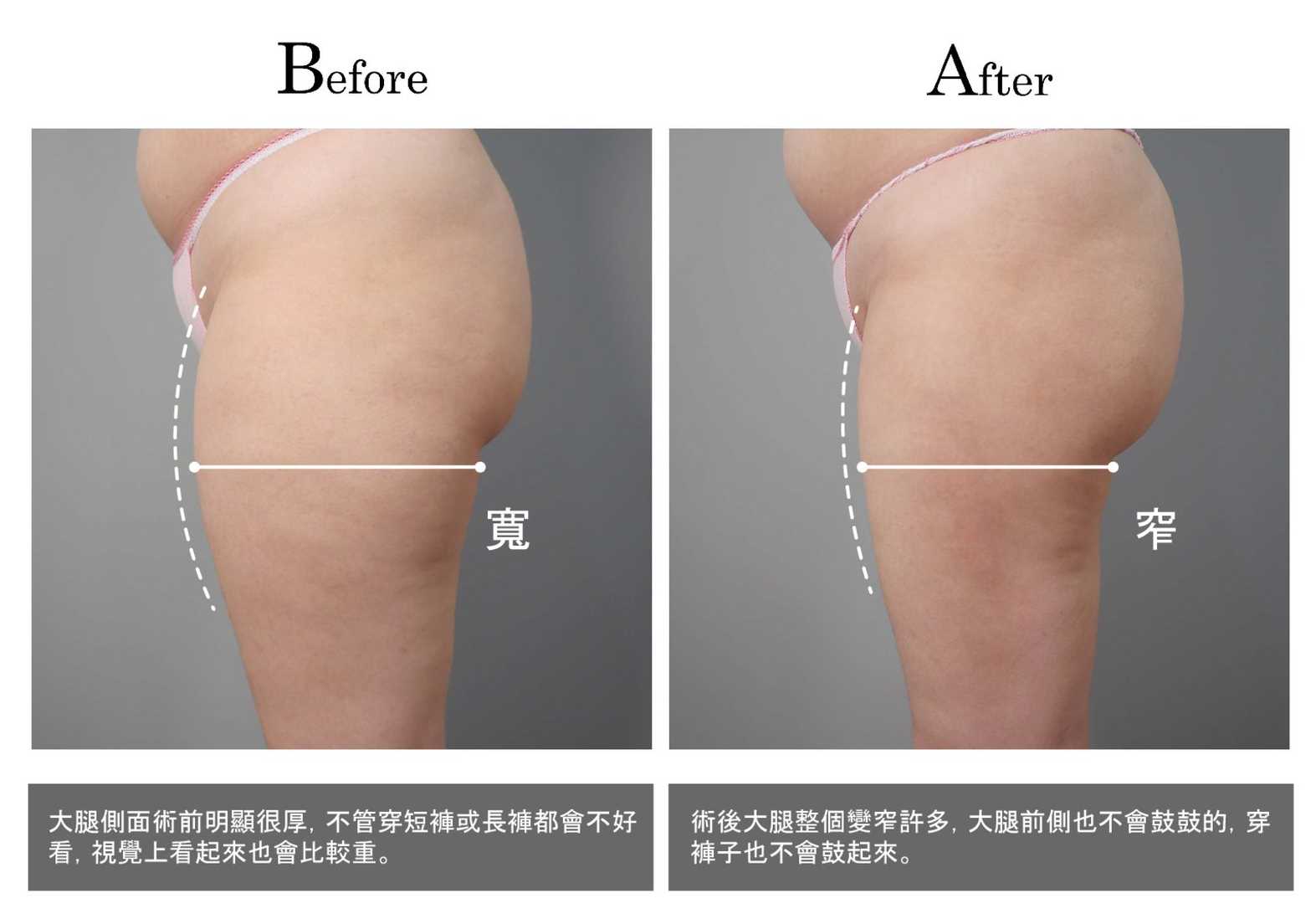 高雄抽脂手術_永恆醫美