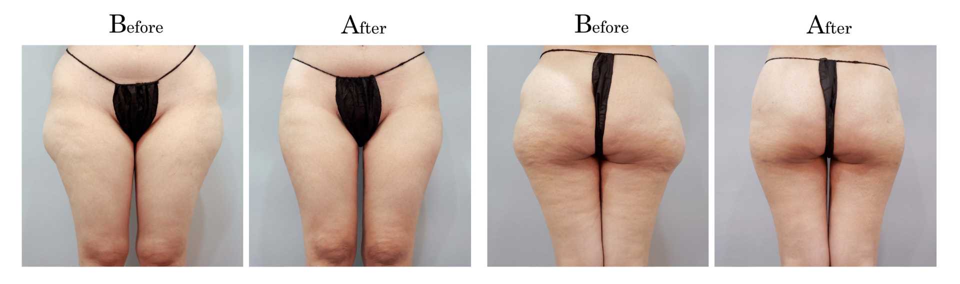 高雄抽脂手術_永恆醫美