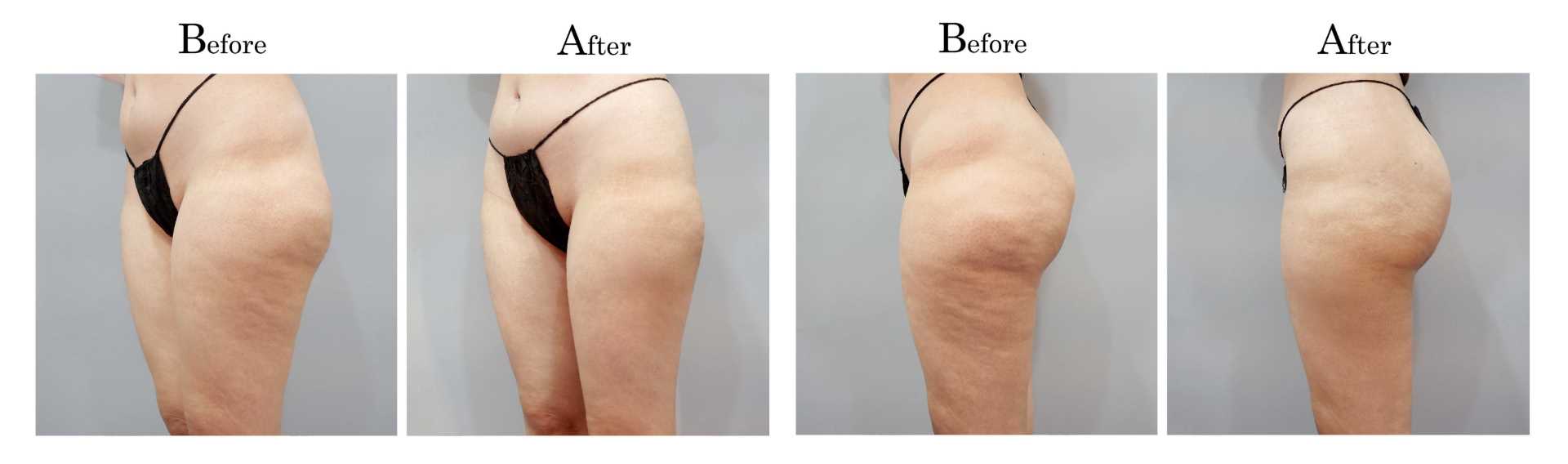 高雄抽脂手術_永恆醫美