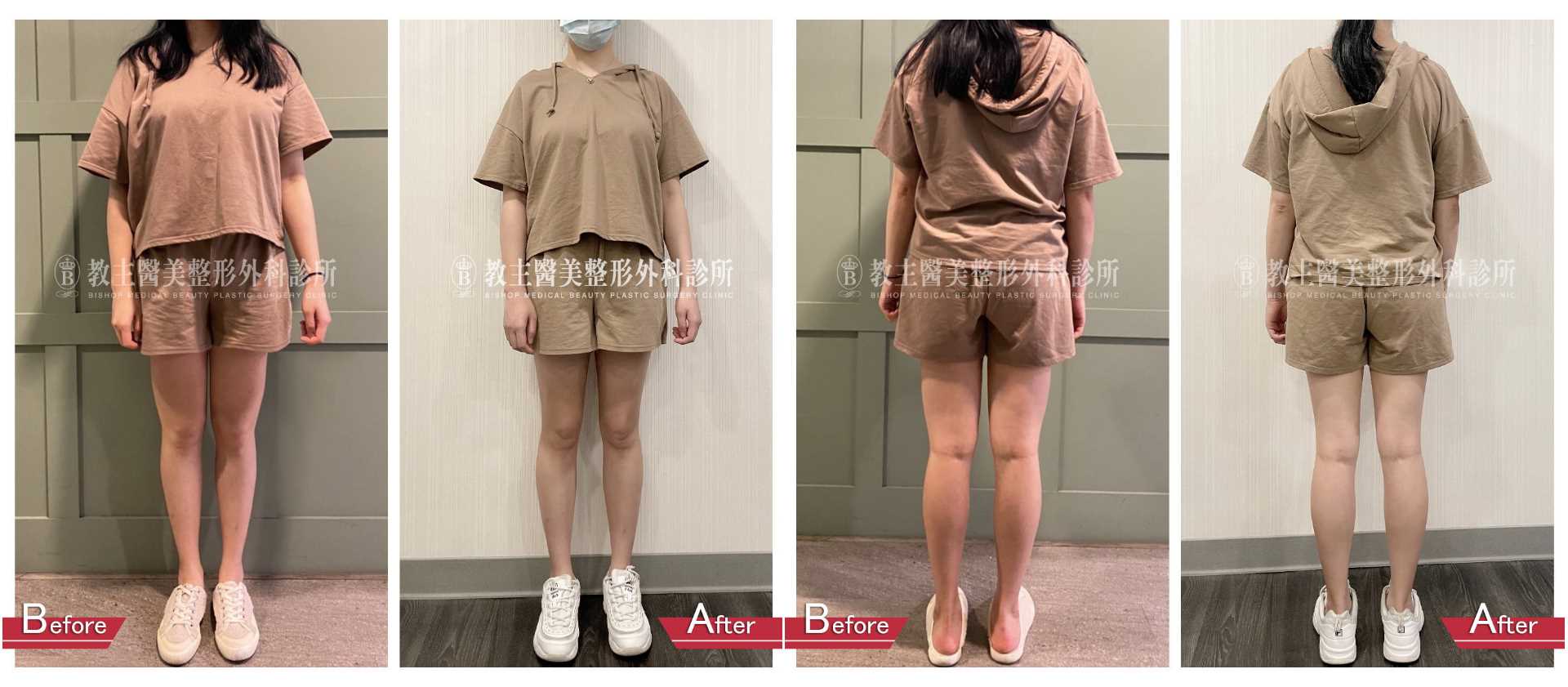 高雄抽脂手術_永恆醫美