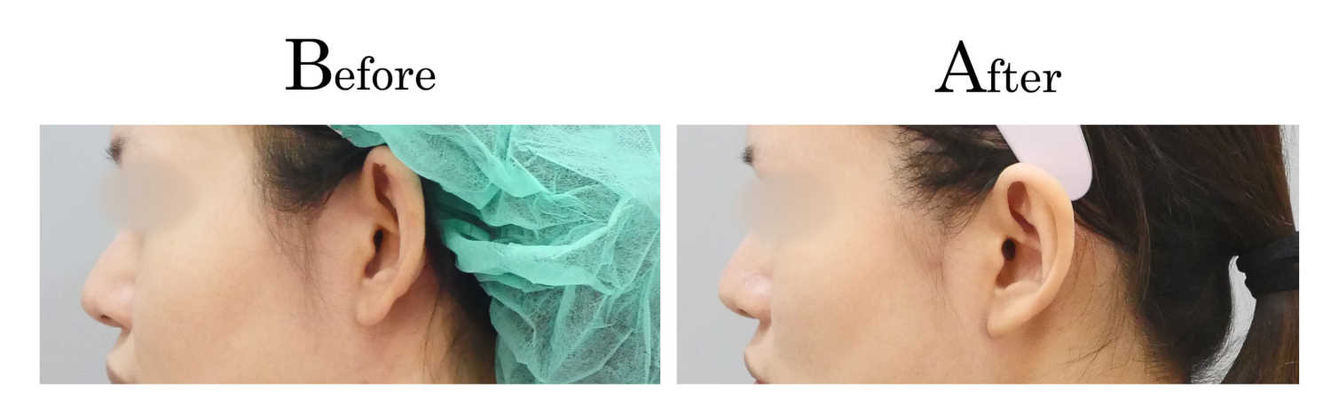 高雄耳朵整形招風耳.大耳縮.小耳垂修復形狀改善價格費用權威醫師推薦12