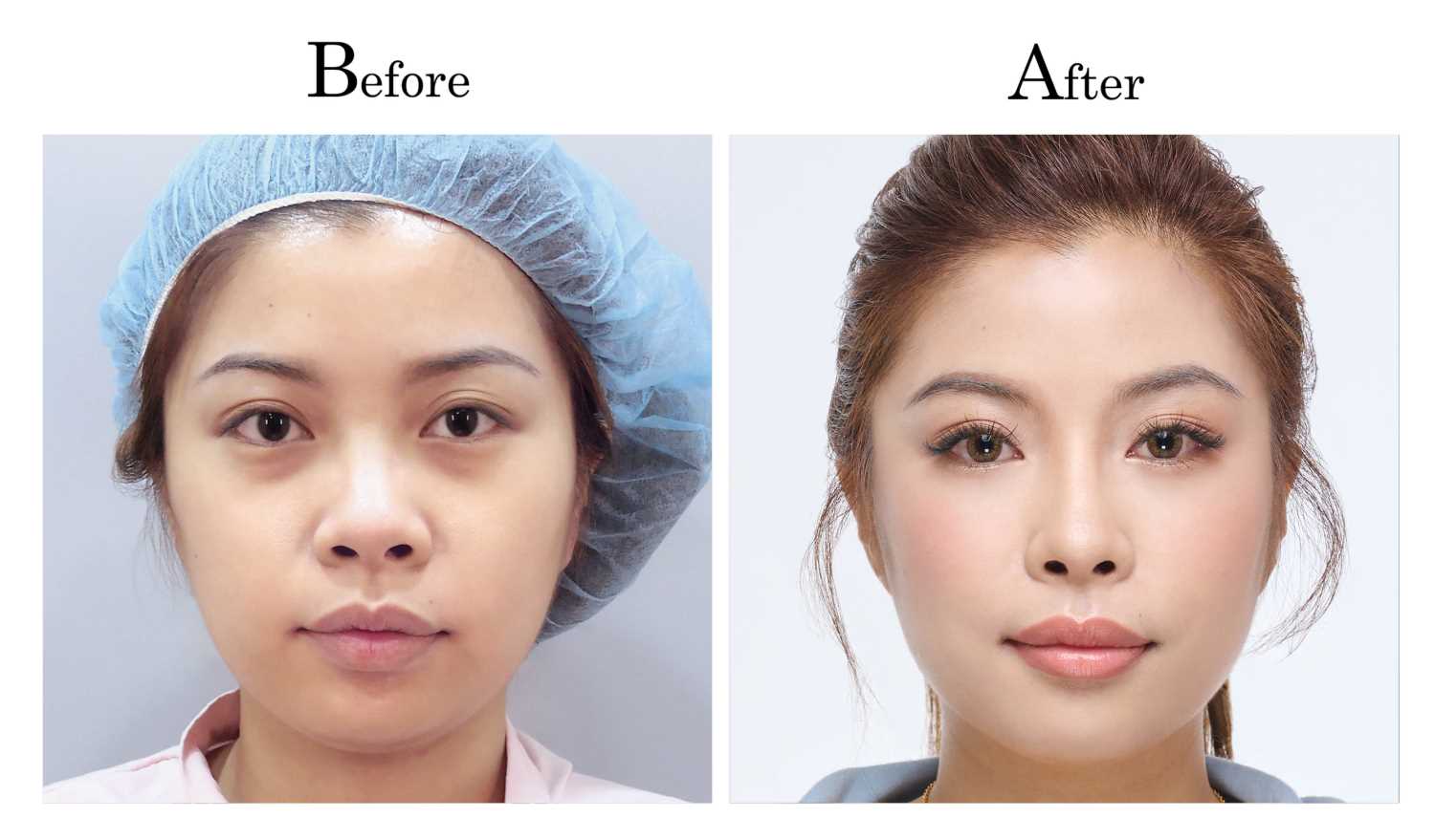 高雄三段式隆鼻整形何旭爵醫師案例1_1