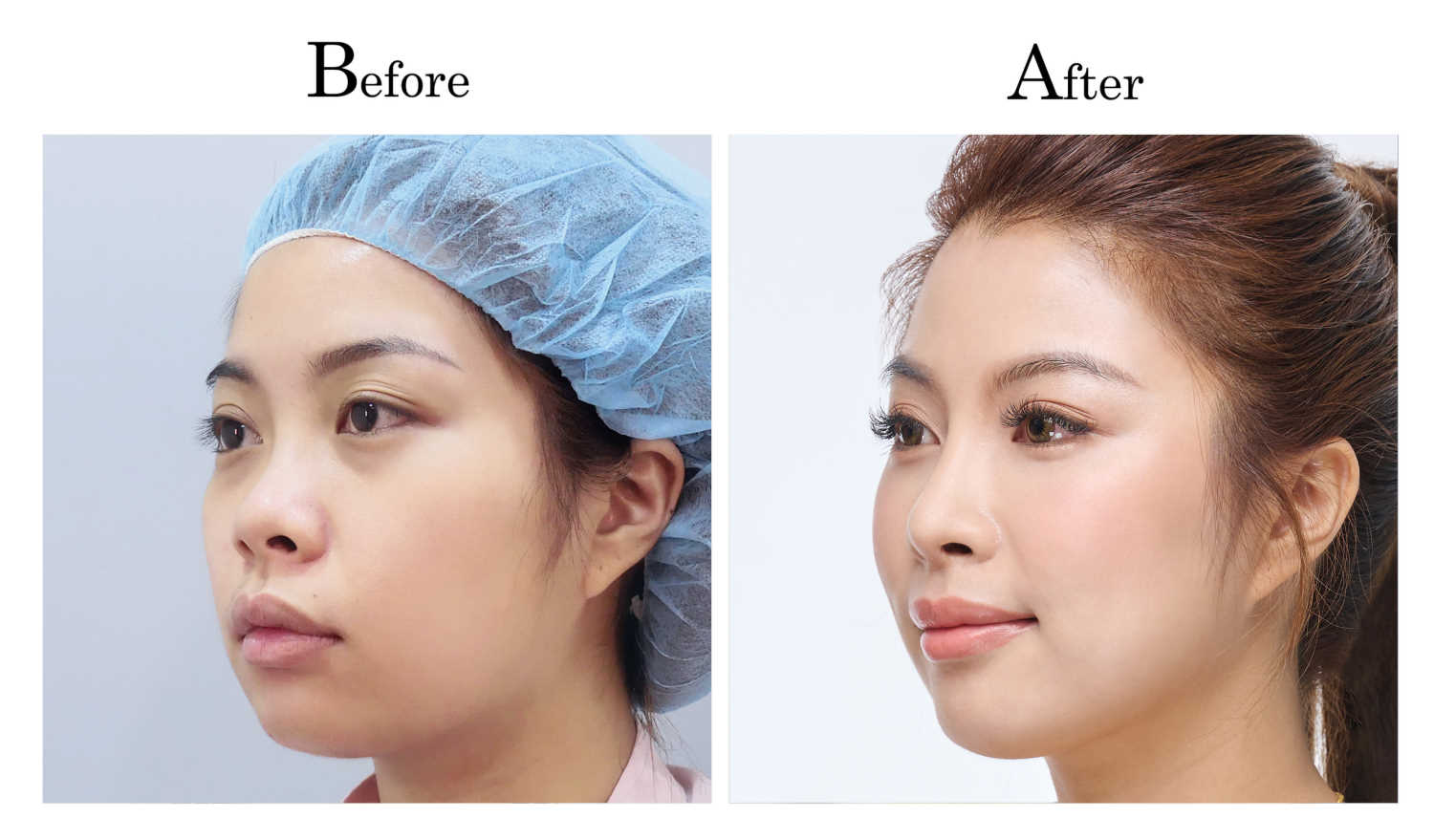 高雄三段式隆鼻整形何旭爵醫師案例1_2