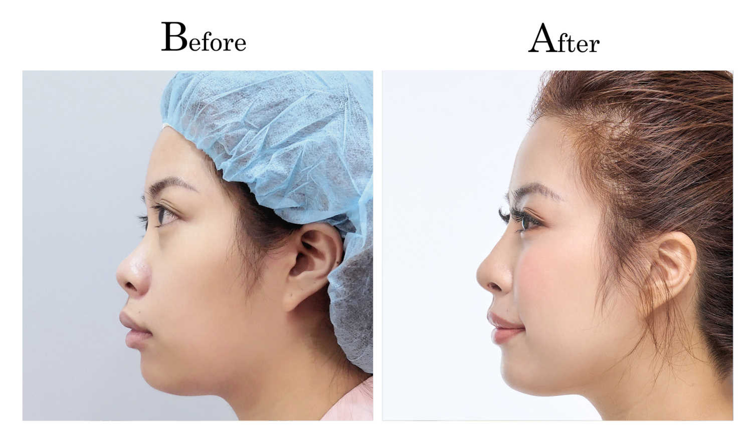 高雄三段式隆鼻整形何旭爵醫師案例1_3