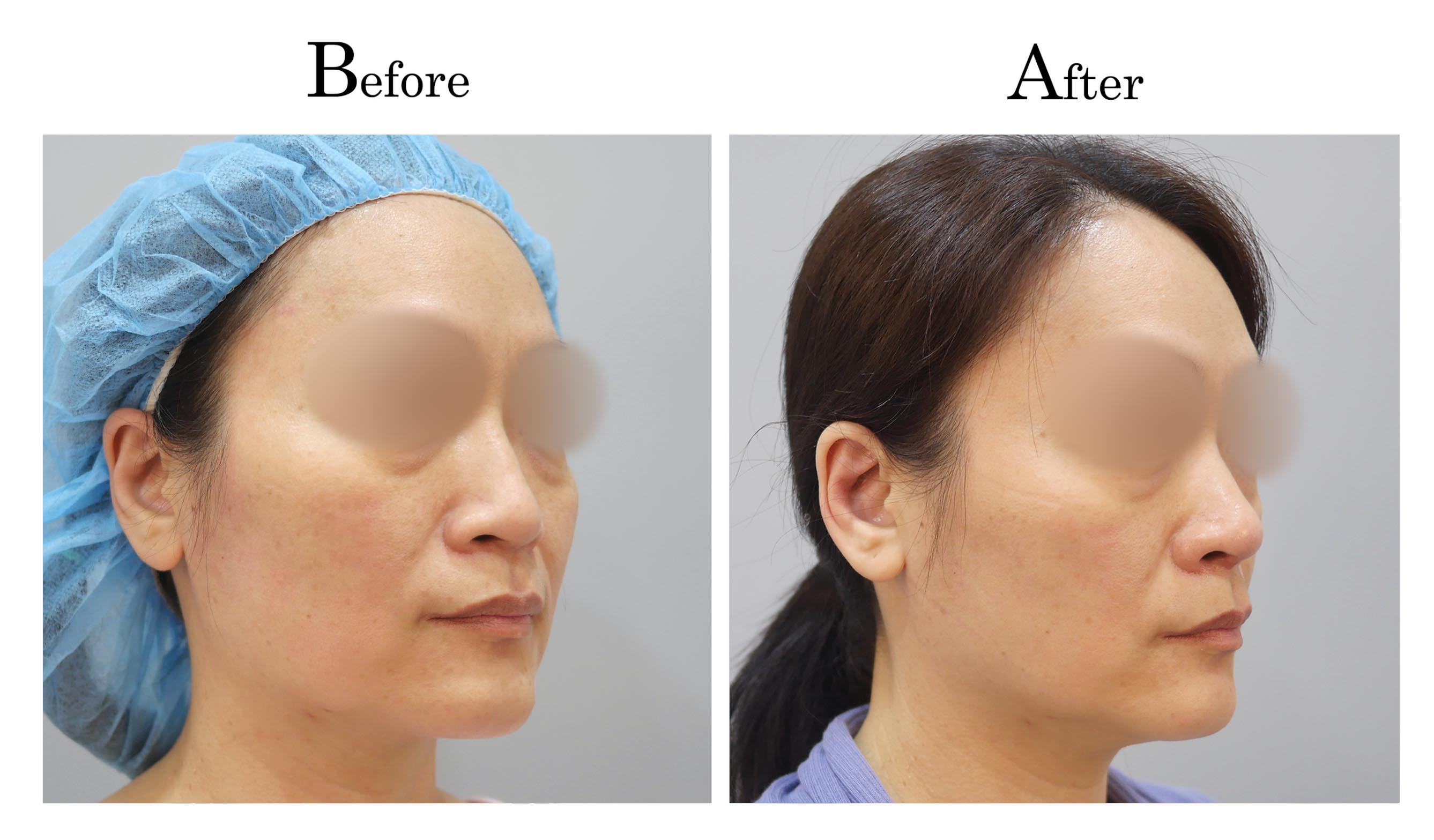 高雄三段式隆鼻整形何旭爵醫師案例2_2