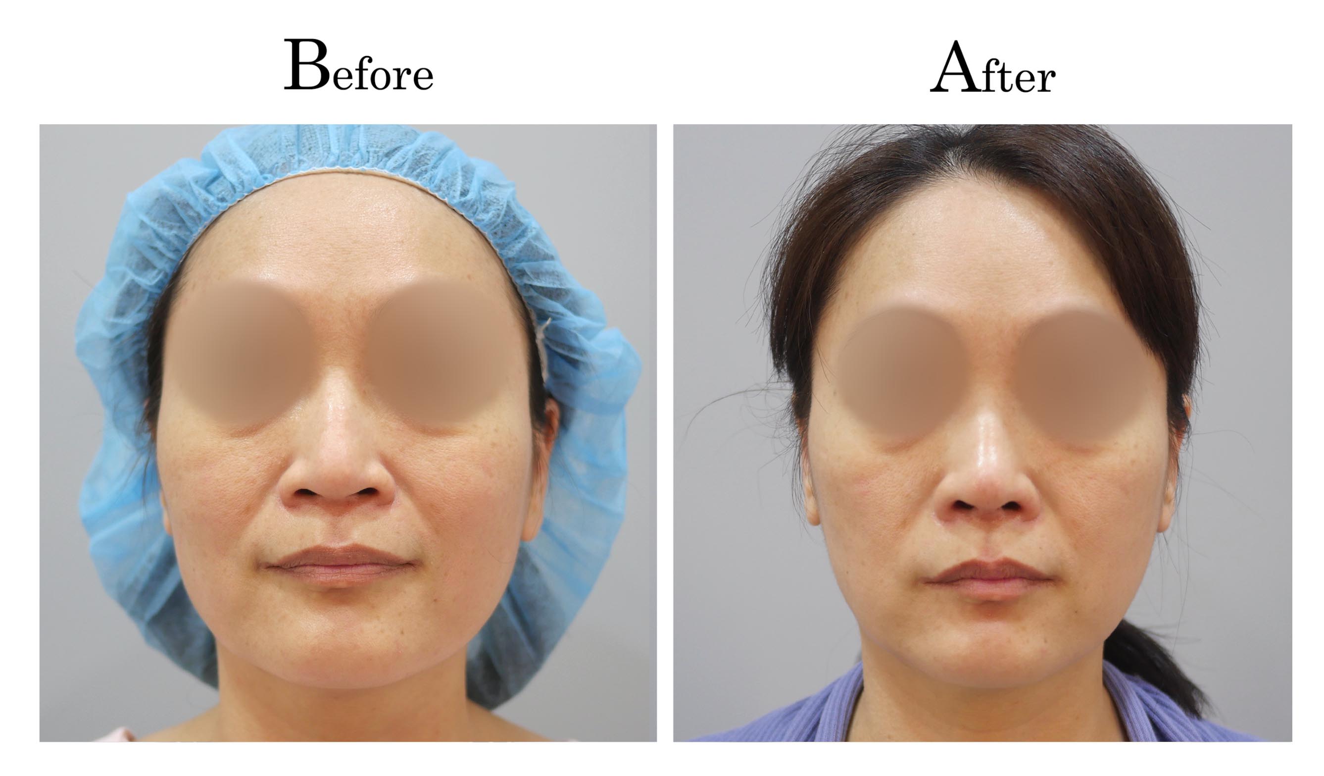 高雄三段式隆鼻整形何旭爵醫師案例2_1