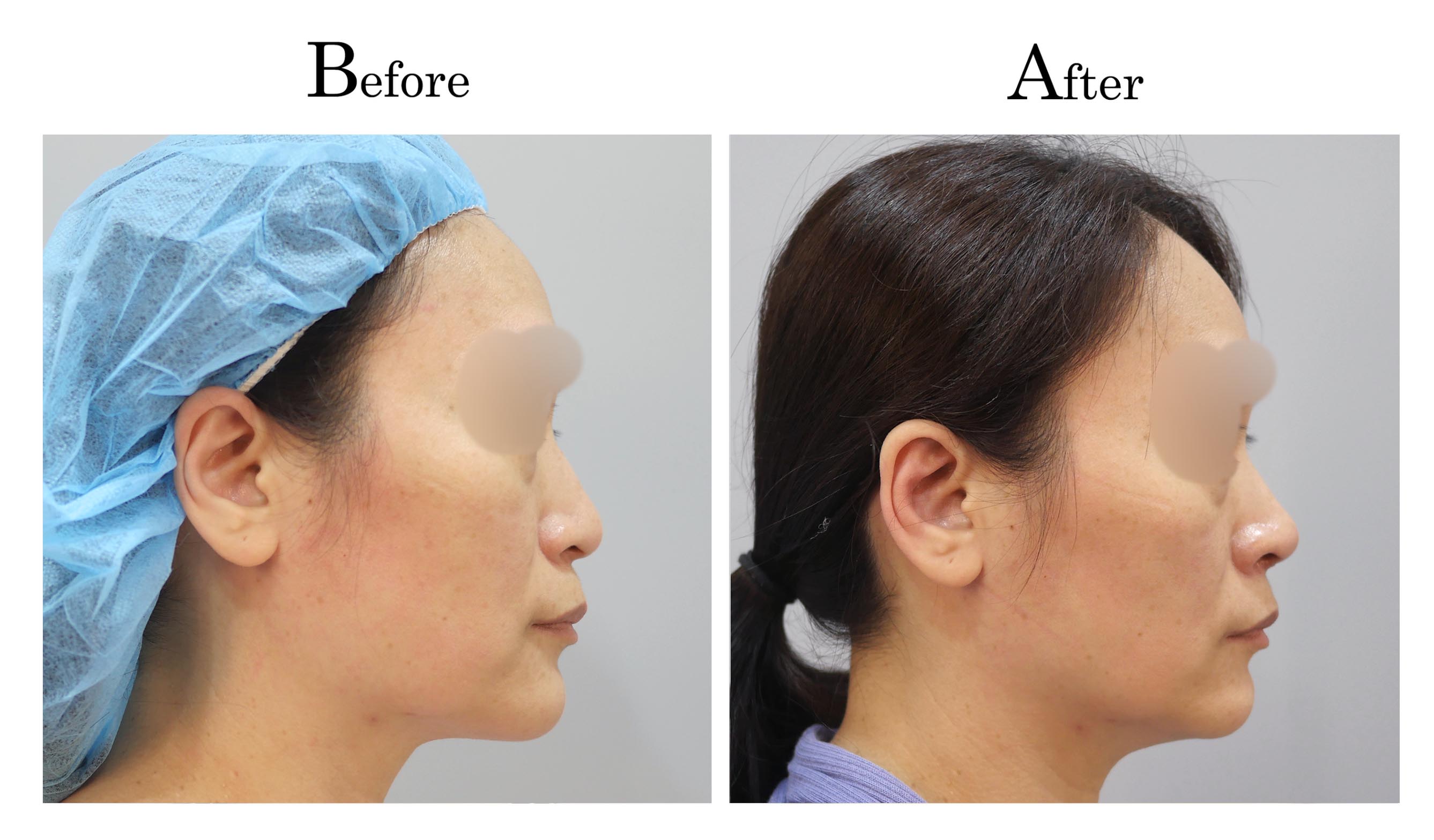 高雄三段式隆鼻整形何旭爵醫師案例2_3