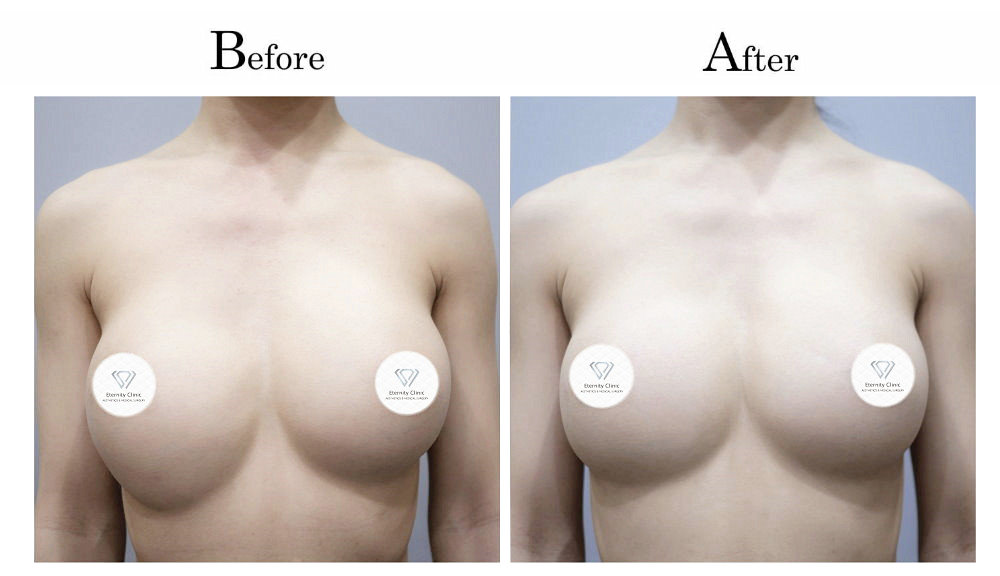 高雄隆乳失敗隆乳後胸部ㄧ高ㄧ低（高低胸）001