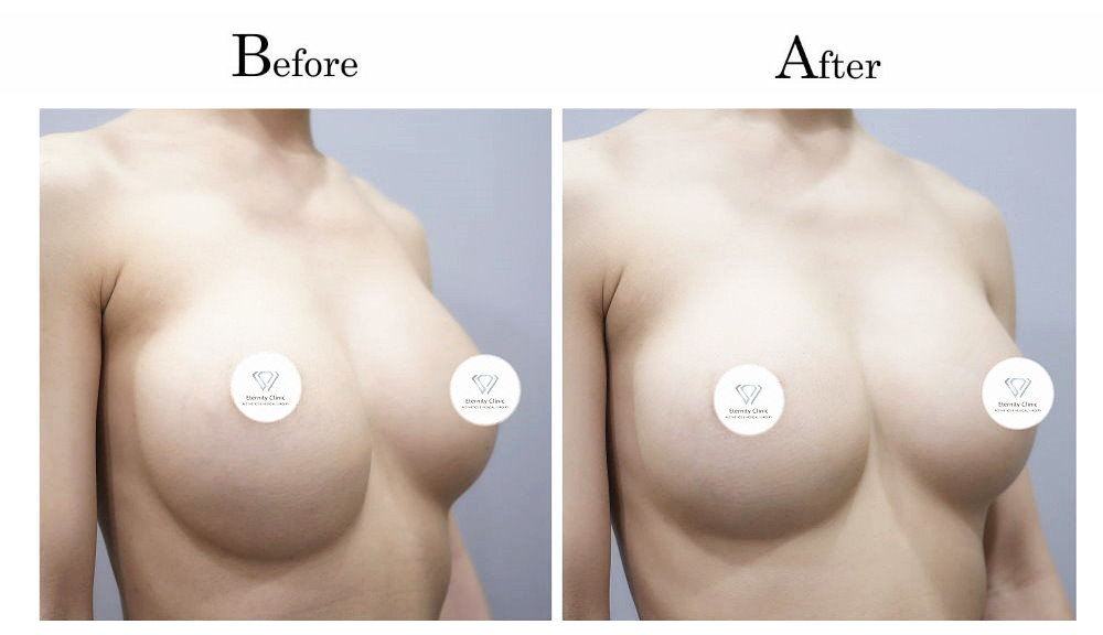 高雄隆乳失敗隆乳後胸部ㄧ高ㄧ低（高低胸）002