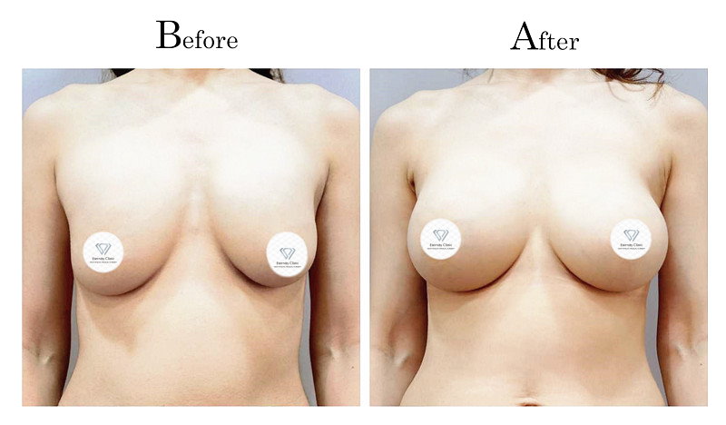 高雄隆乳失敗莢膜攣縮（石頭奶）001