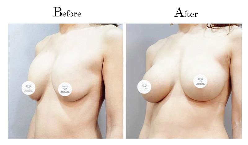 高雄隆乳失敗莢膜攣縮（石頭奶）002