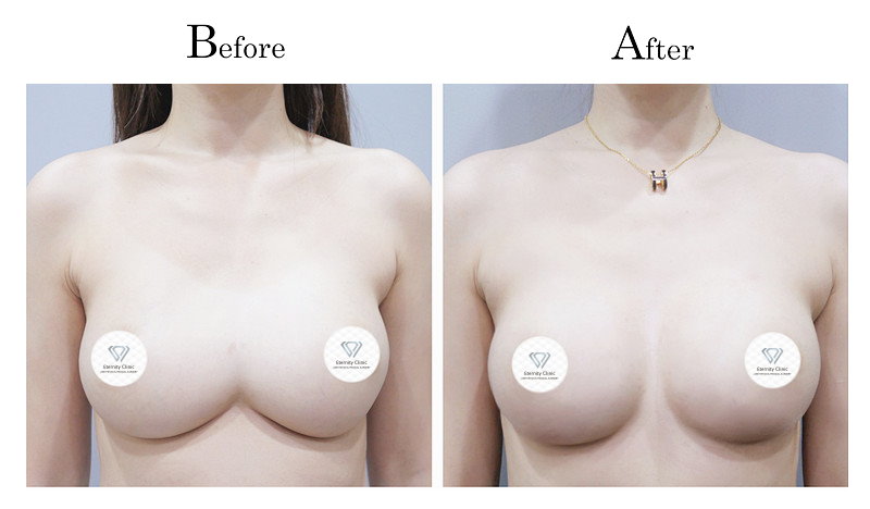 高雄隆乳失敗隆乳後造成兩乳房連在一起（連通奶）001