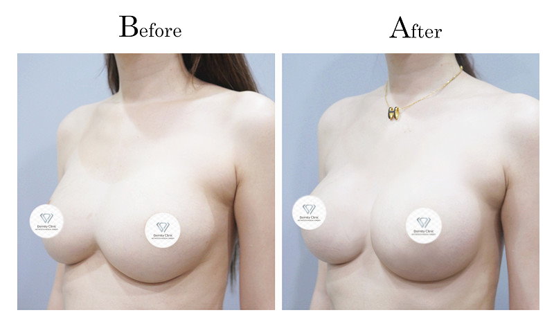 高雄隆乳失敗隆乳後造成兩乳房連在一起（連通奶）002